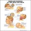 WHIPLASH Injuries of the Head and Neck Anatomical Chart