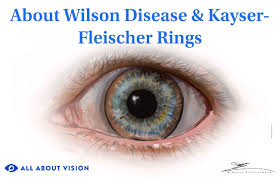 Kuvahaun tulos haulle Kayser-Fleischer