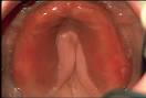 <b>denture stomatitis</b> pic