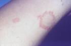 Erythema Nodosum
