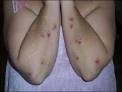 of Morgellons Disease