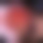 Image result for "proud flesh"