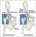 hip dysplasia.jpg