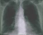 fibrosi <b>polmonare</b>