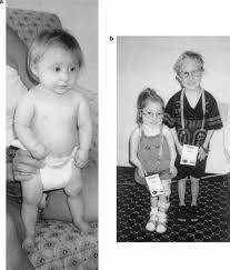 Image result for Nanismo Primordial