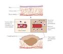 Fungating Wound
