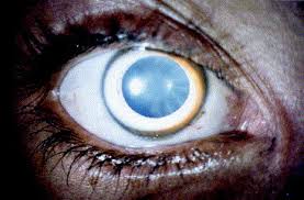 Kuvahaun tulos haulle Kayser-Fleischer