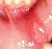 Aphthous ulcer - Wikipedia, the free encyclopedia