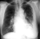 This is a case of <b>mesothelioma</b>