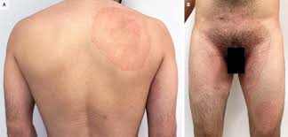 Image result for tinea corporis