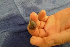 Attēlu rezultāti vaicājumam “Scleroderma”