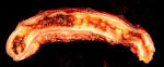 <b>APPENDICITIS</b>