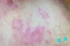 Image result for tinea corporis