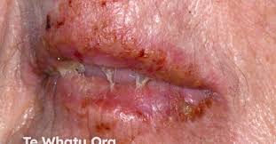 Attēlu rezultāti vaicājumam “Diderma simplex sessile”