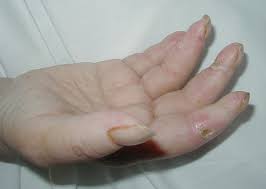 Attēlu rezultāti vaicājumam “Scleroderma”