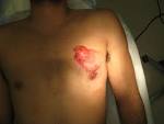 File:<b>Gynecomastia</b> Corrective