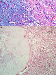 Attēlu rezultāti vaicājumam “Diderma chondrioderma sessile”