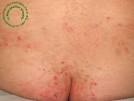 <b>dermatite herpetiforme</b>