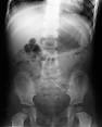 <b>X</b>-<b>ray</b> of one-year old showing
