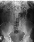 File:Rectal <b>foreign body</b> 04.jpg - Wikimedia Commons