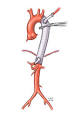 Aortic aneurysm surgically