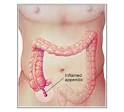 <b>appendicitis</b>.jpg