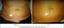 Exilis Downie B A StomachJPG