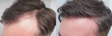 Image result for Liverpool Transplant FC