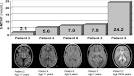 <b>Kearns</b>-<b>Sayre syndrome</b>: