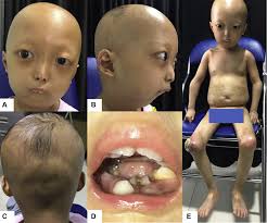 Attēlu rezultāti vaicājumam “Lycogala asperum young”