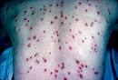 <b>syphilis</b> symptoms