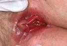 Yeast Infections is treated without pills | Health32.