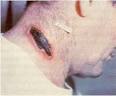 ACP - Bioterrorism Resource Center: Cutaneous Anthrax
