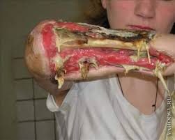 After effects of the Russian designer drug Krokodil