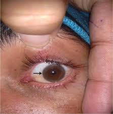 Kuvahaun tulos haulle Kayser-Fleischer