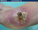 <b>bacterial infections</b> was