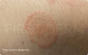 Image result for tinea corporis