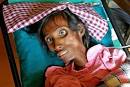 AIDS. chlamydia