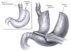 Transhiatal Esophagectomy