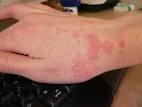Characteristics of <b>Scabies</b>