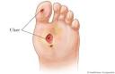 <b>Diabetic Foot</b> Ulcer