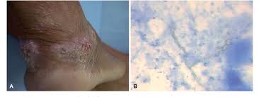 Attēlu rezultāti vaicājumam “Colloderma sp.”