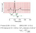 CV Physiology: Electrocardiogram (EKG, ECG)