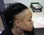Traction <b>alopecia</b> occurs more