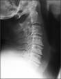 Cervical Spinal Stenosis
