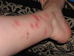 Image result for bed bug bites
