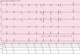 <b>Blocco senoatriale</b> - Wikipedia