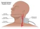 Carotid Artery Duplex Scan