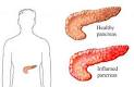 In <b>pancreatitis</b>, the digestive