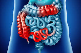 Image result for boala crohn si schizofrenie paranoida